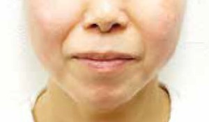 症例：スレッドリフト 施術4週間後
