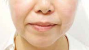 症例：スレッドリフト 施術前